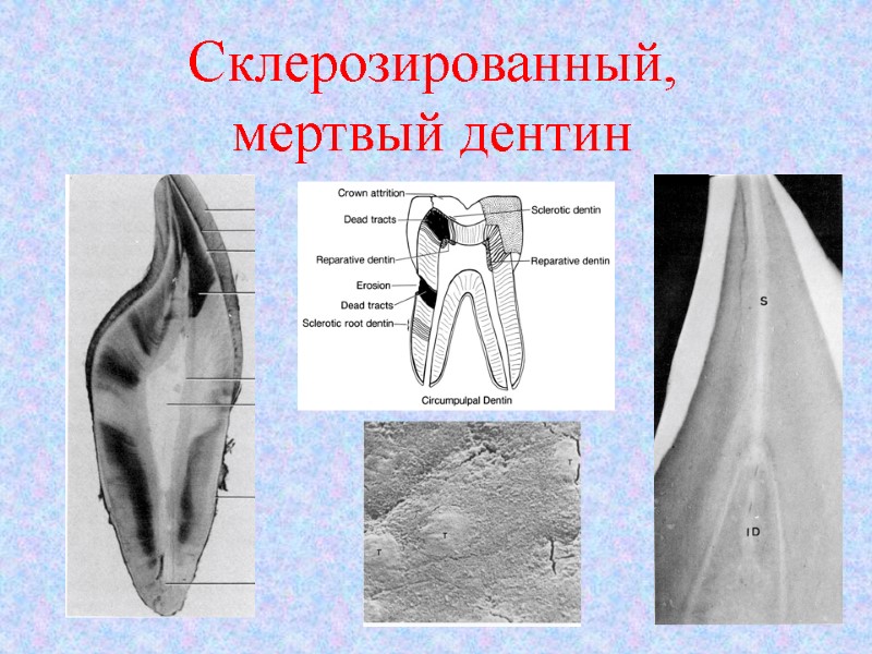 Склерозированный,   мертвый дентин